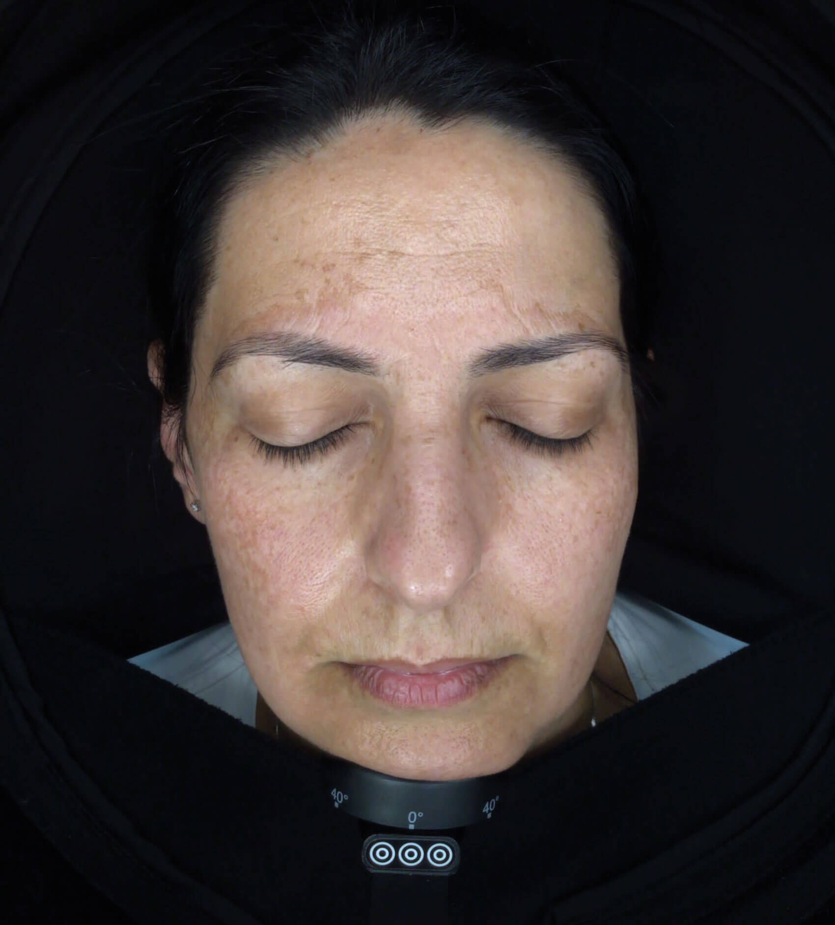 Luminescens® protocol article image showing patient before treatment.