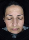 Luminescens® protocol article image showing patient before treatment.