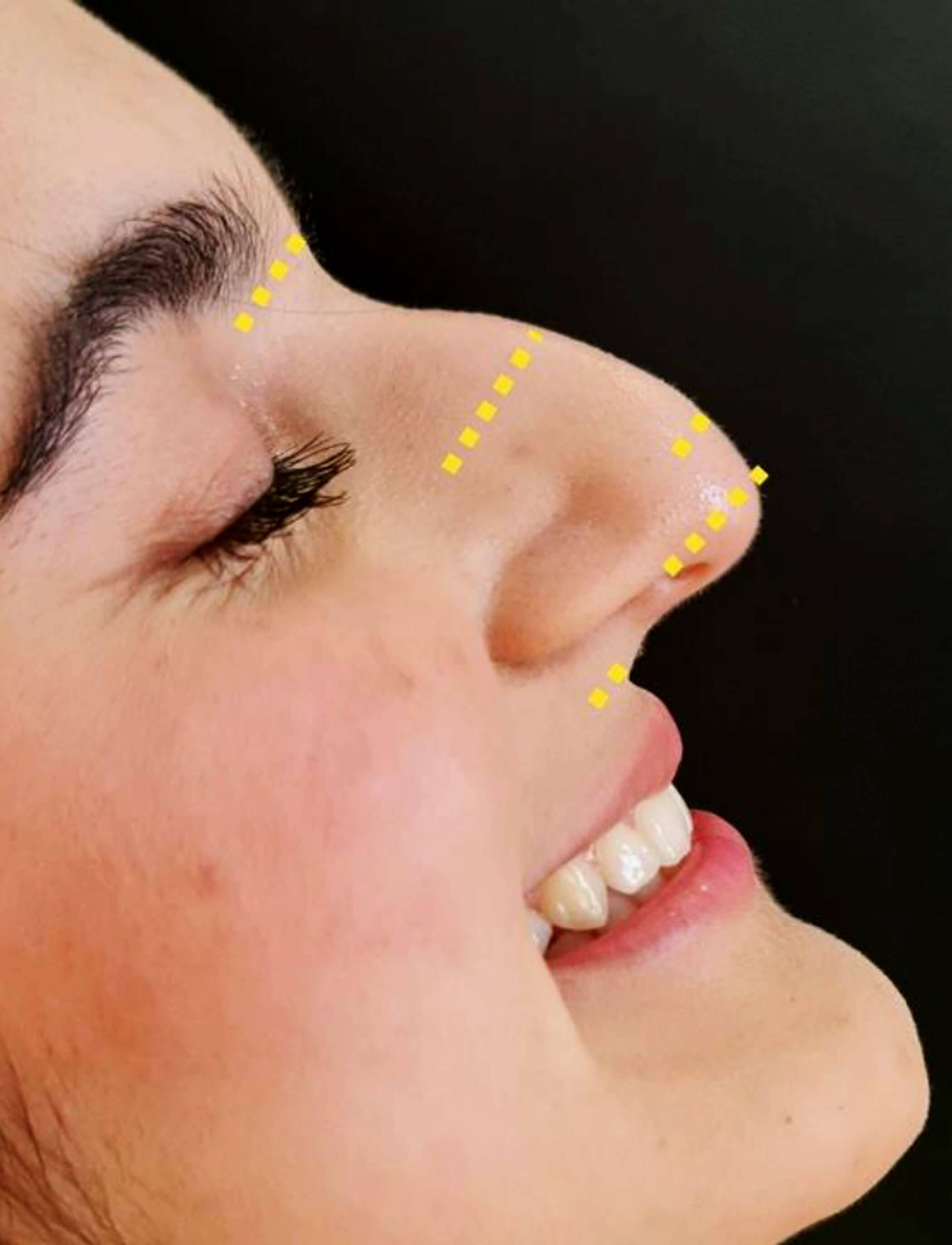 Non-surgical rhinoplasty article image showing key anatomical landmarks. 