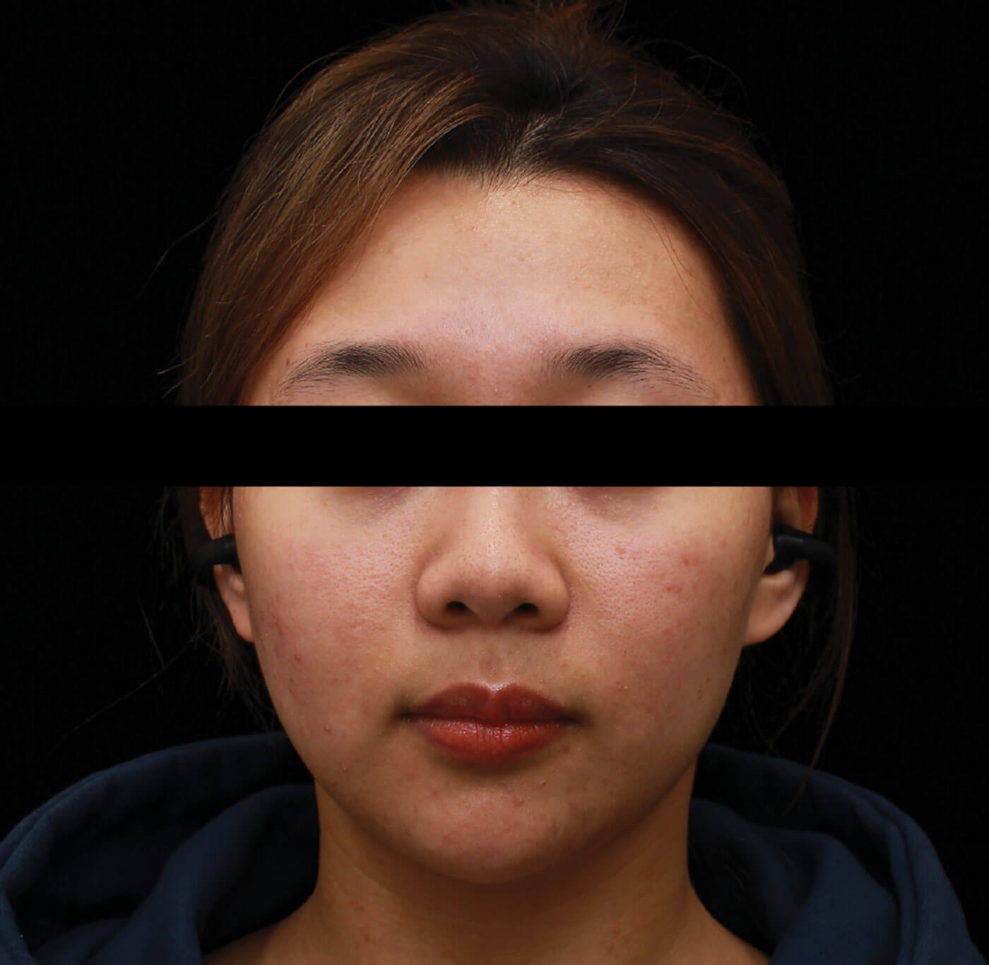 Facial modification with Fotona article image showing after one session treatment.