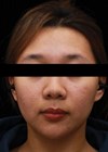 Facial modification with Fotona article image showing after one session treatment.