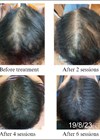 Photos showing vertex view before treatment and after subsequent treatment sessions.