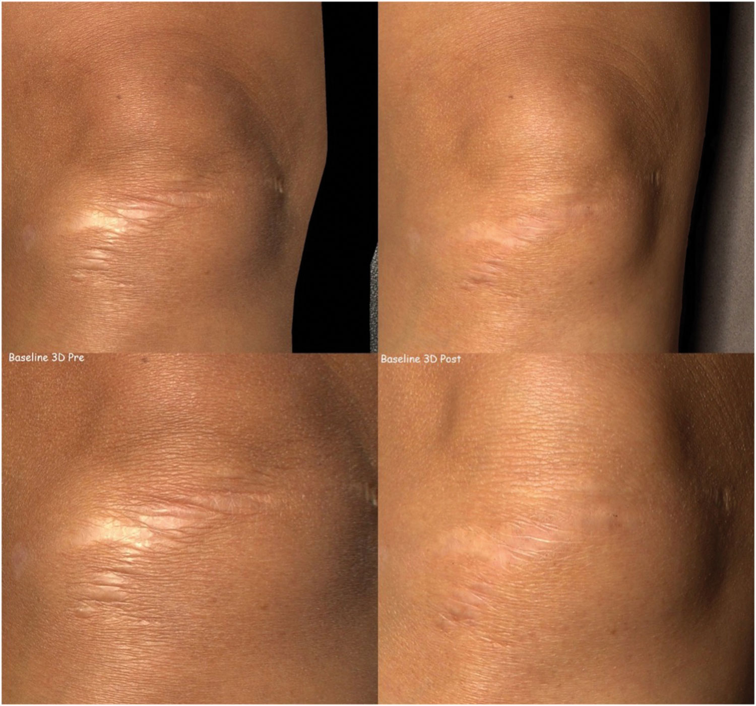 Photos showing HB 3D baseline pre & post comparison knee scar. 
