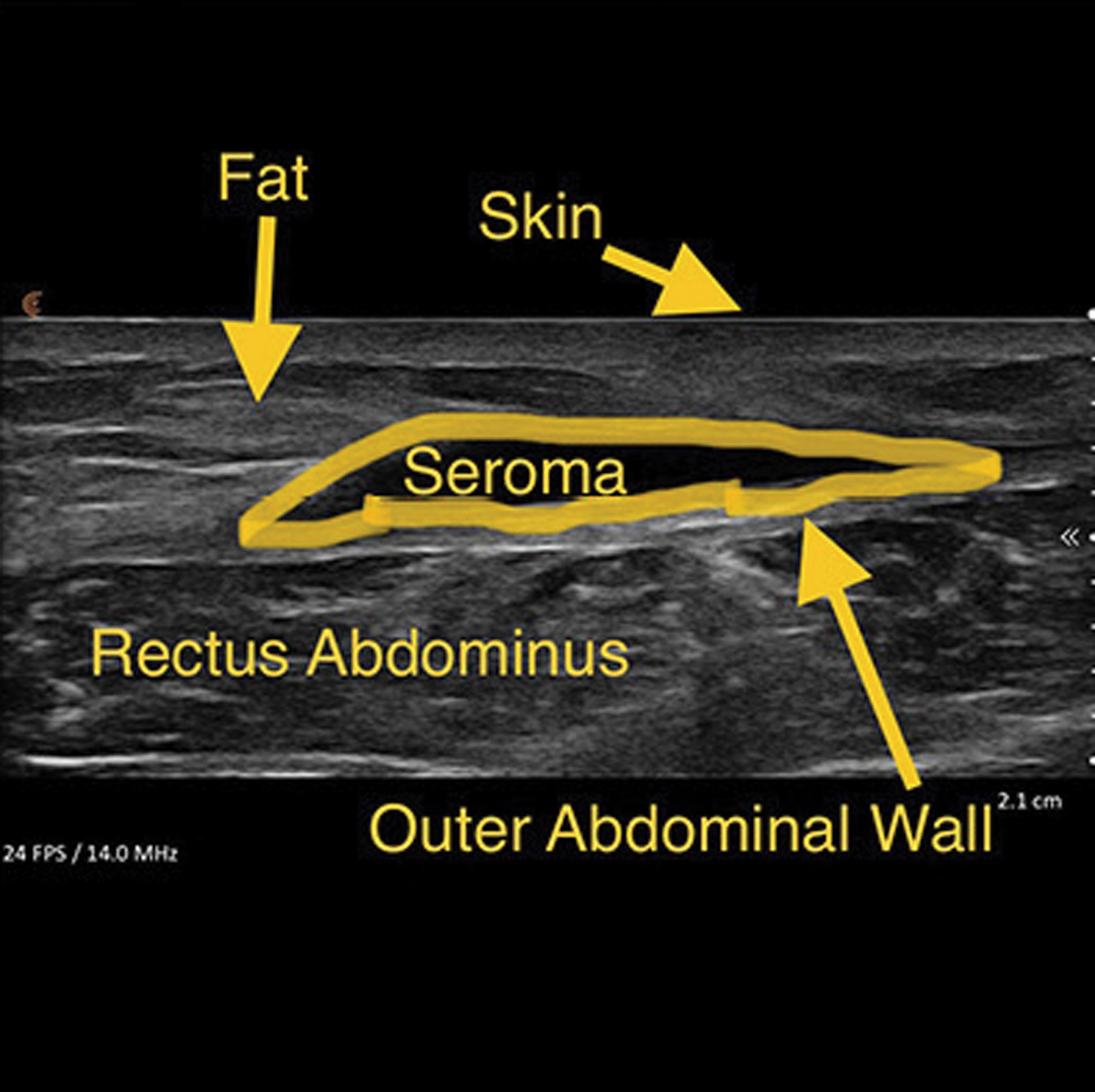 Scan of post abdominoplasty seroma.