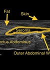Scan of post abdominoplasty seroma.