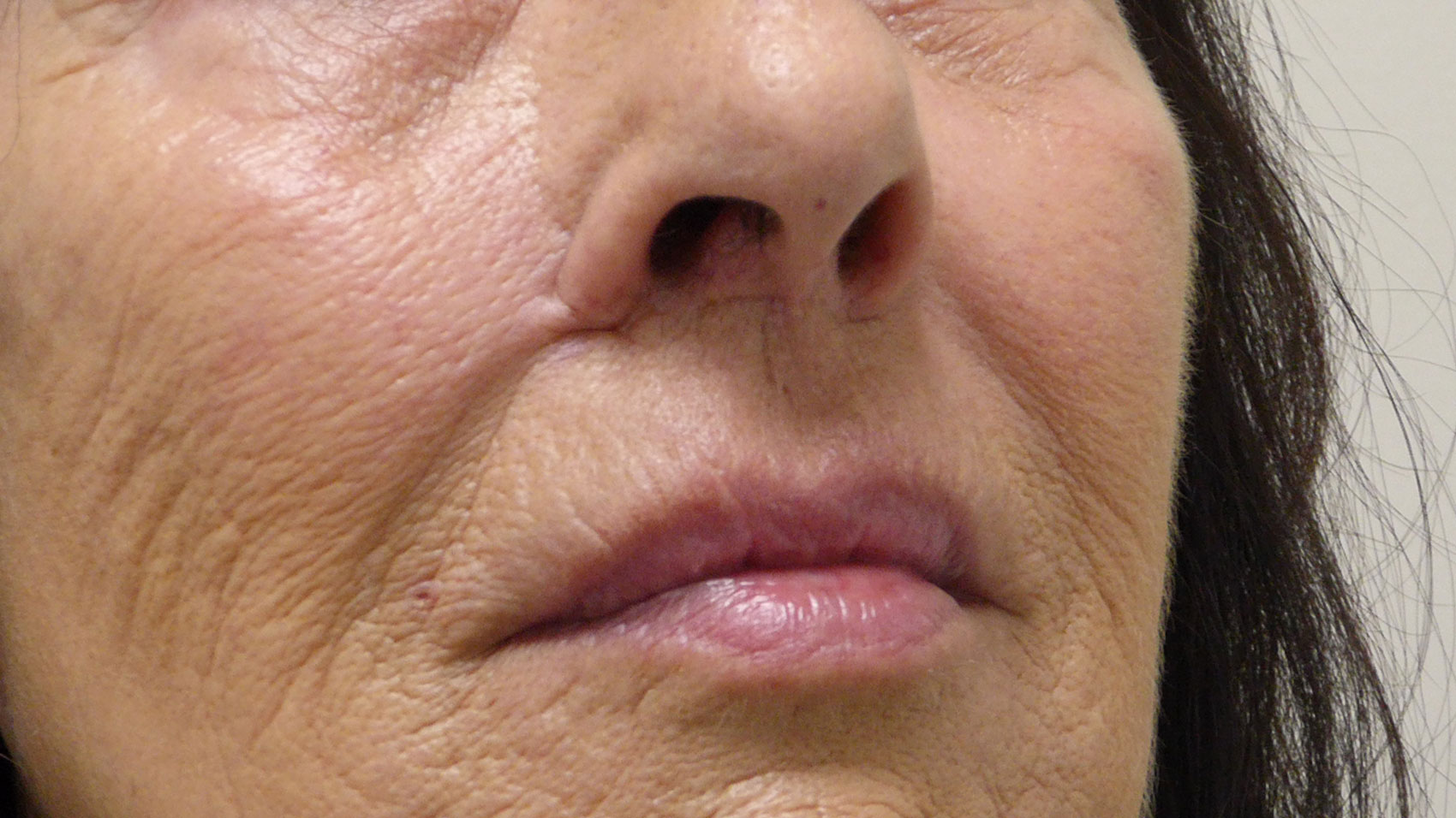 Photo showing completed lip lift with bull-horn flap inset.