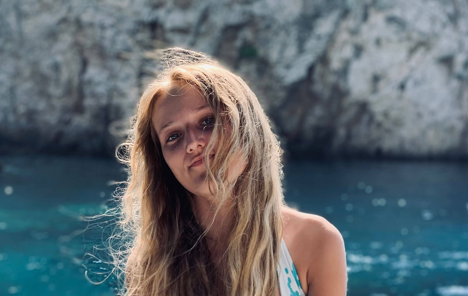 Photo of Chloé who developed keloid scarring following surgery.