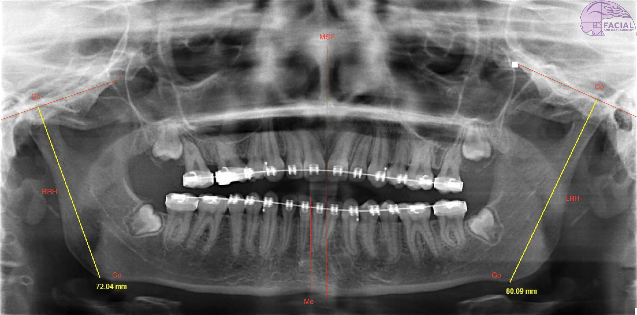 Orthopantomagram image - yaw dominant mandibular asymmetry with chin midline deviation to right.