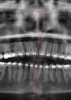 Orthopantomagram image - yaw dominant mandibular asymmetry with chin midline deviation to right.