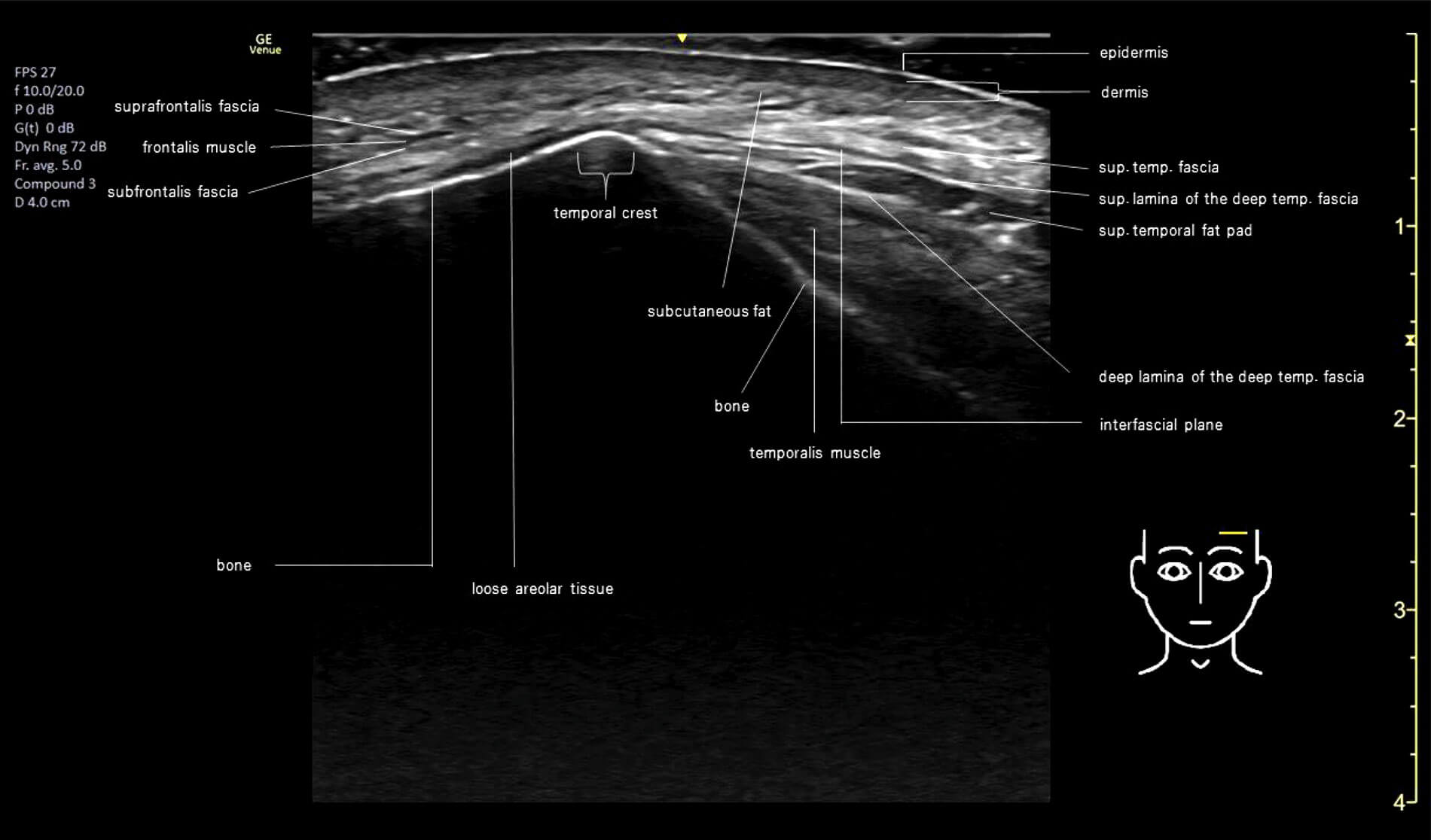 Ultrasound image of layered arrangement of forehead and temples.