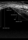 Ultrasound image of layered arrangement of forehead and temples.