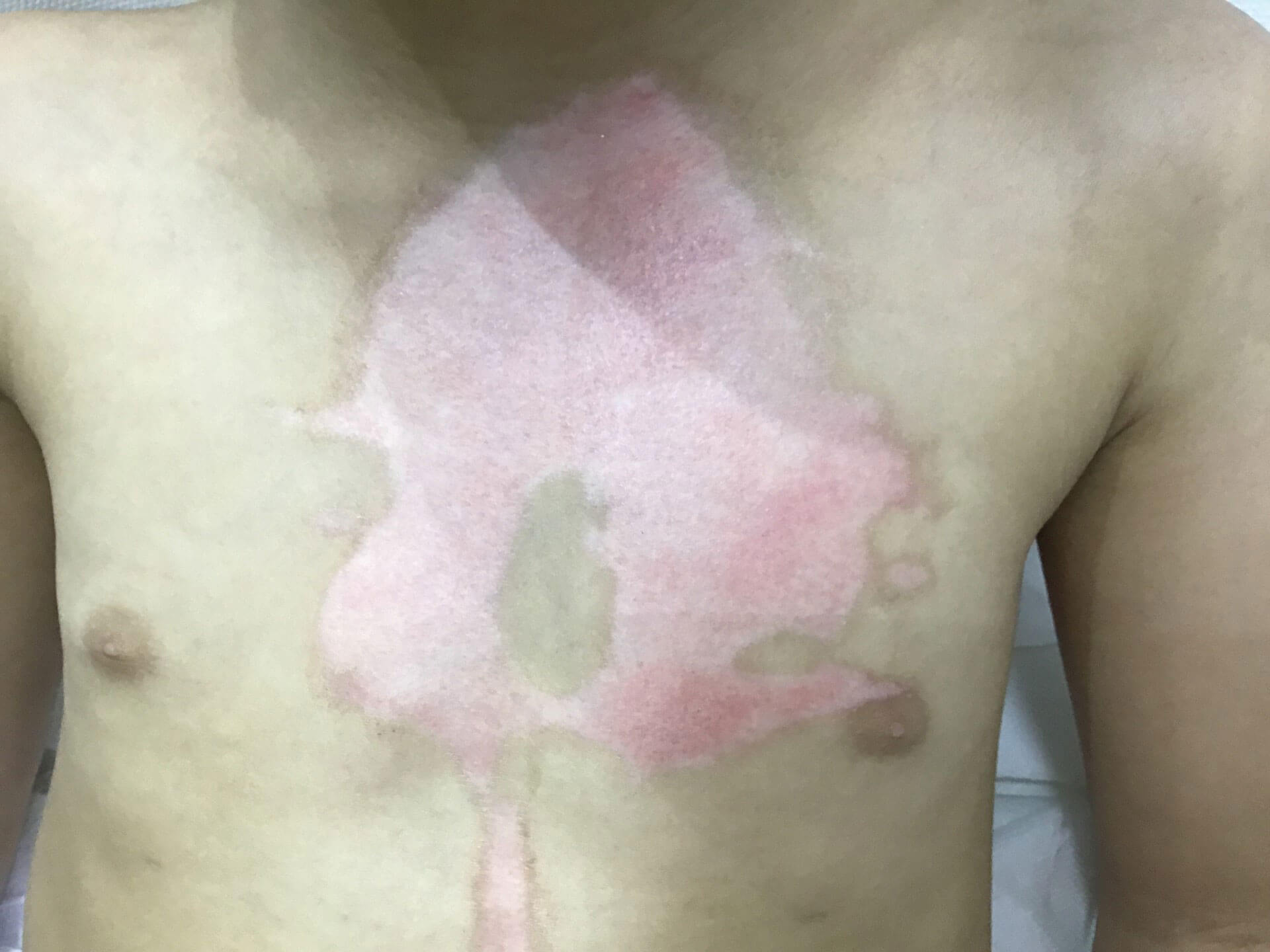 Photo showing ten days after a scald burn to the chest.