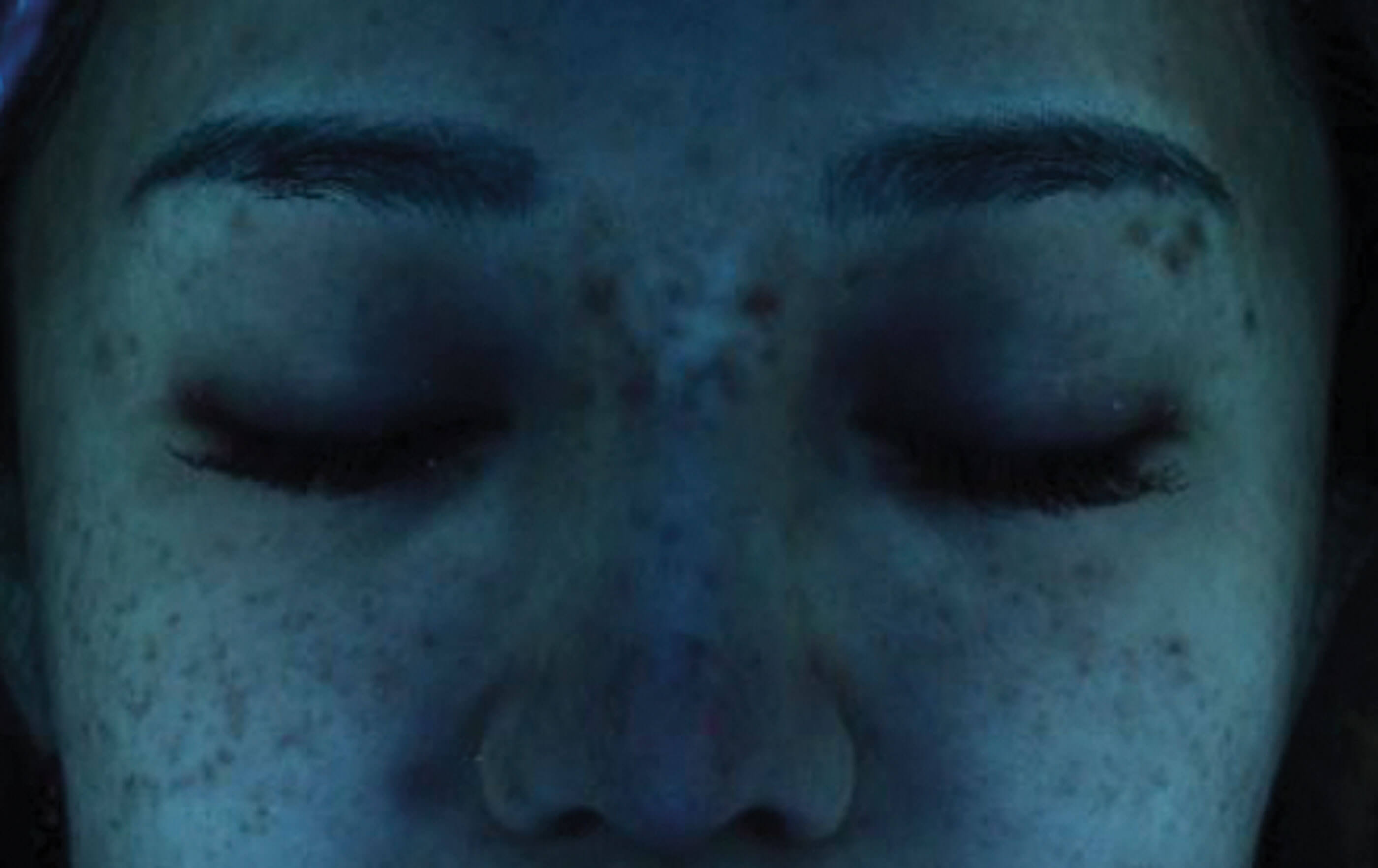 Photo of skin dyspigmentation patient.