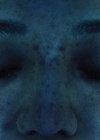 Photo of skin dyspigmentation patient.