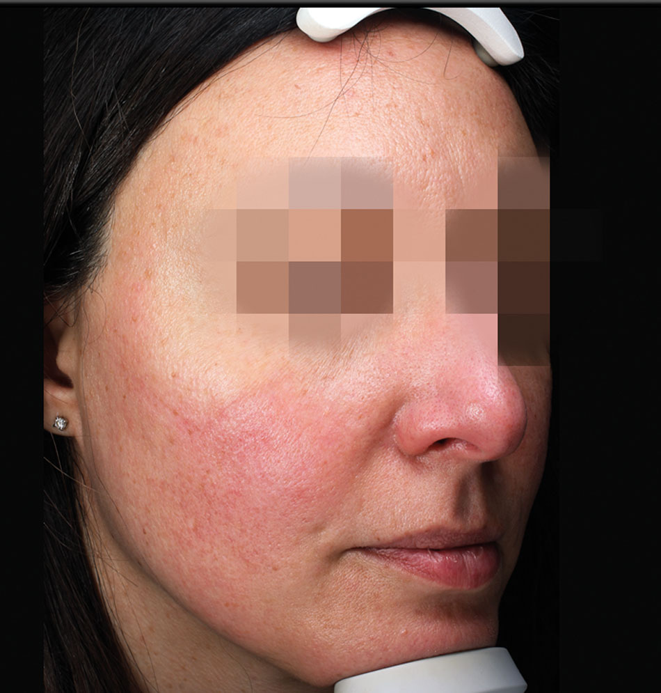 Before image prior to Nordlys SWT® PR 530 treatments for severe acne rosacea.