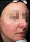 Before image prior to Nordlys SWT® PR 530 treatments for severe acne rosacea.