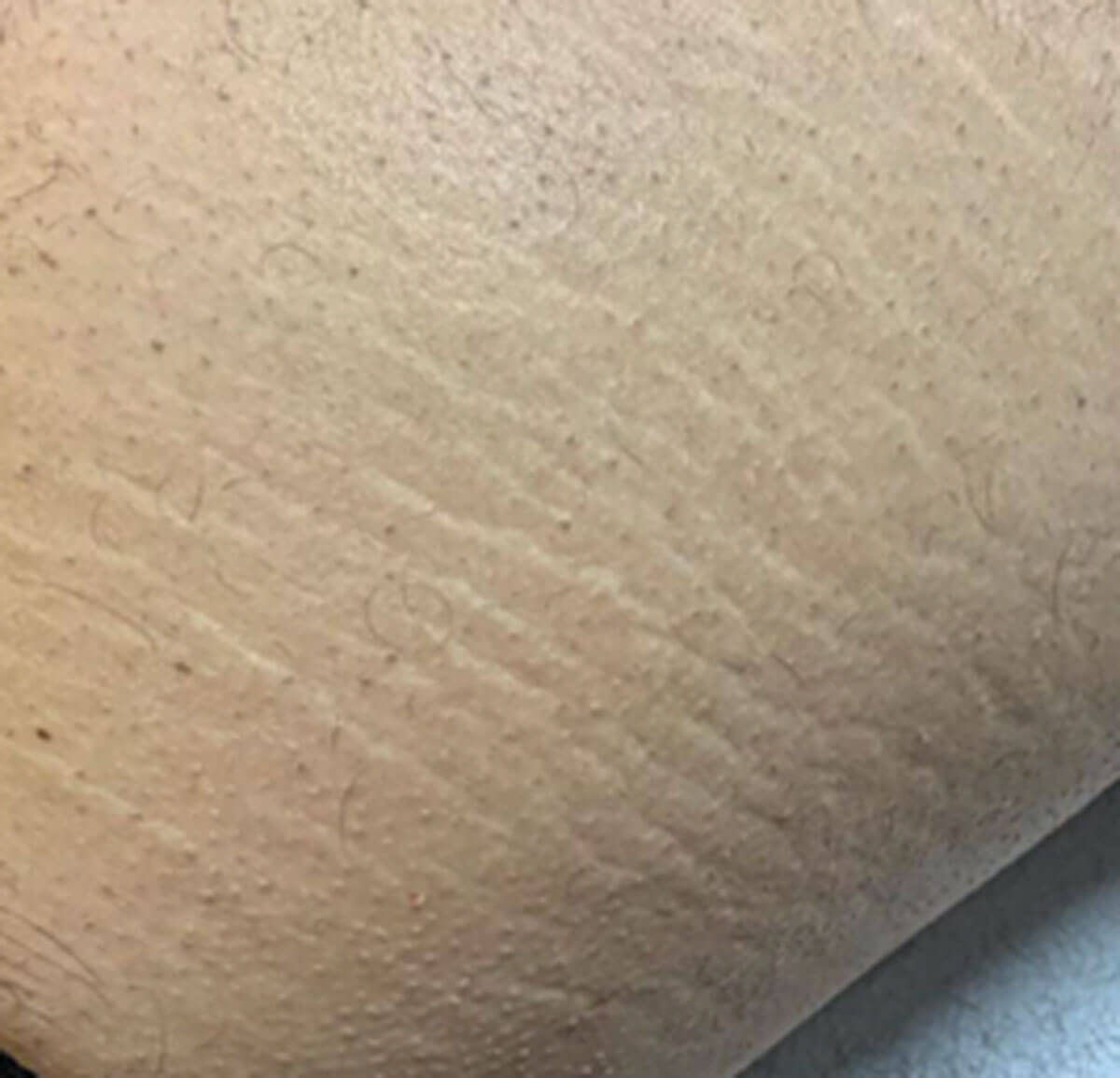 Before image - stretch mark treatment.