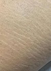 Before image - stretch mark treatment.