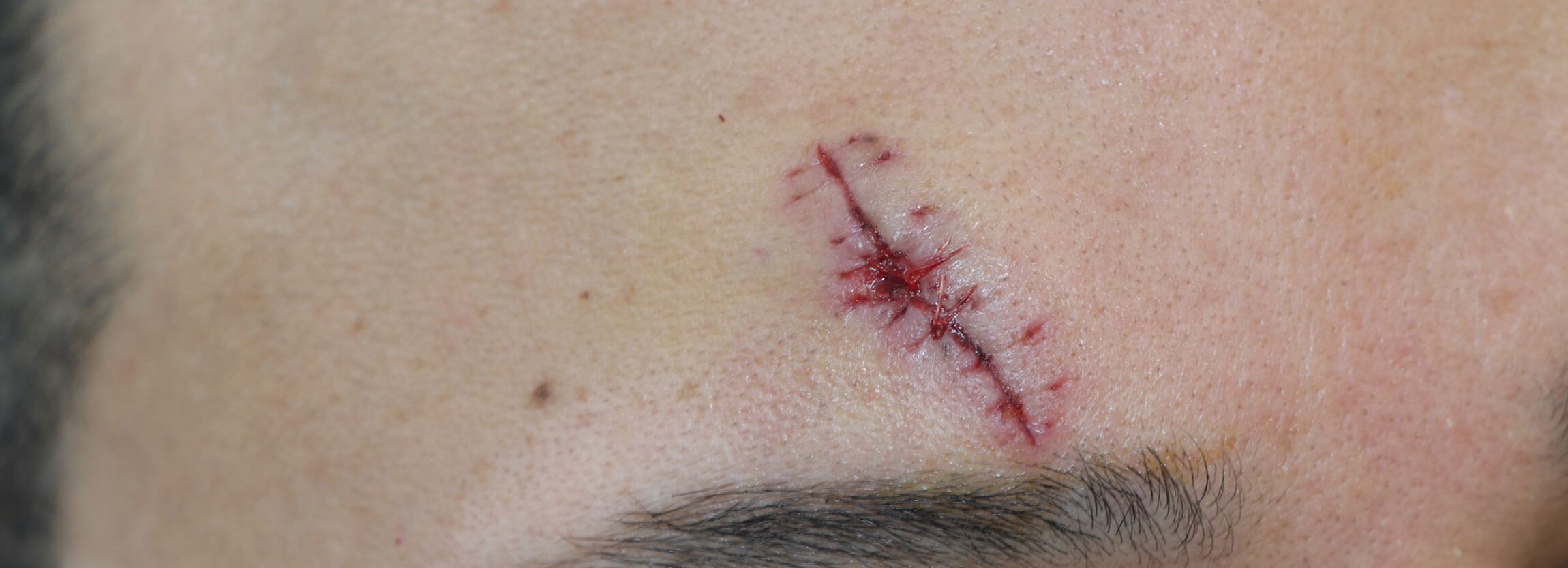 Image of wound before stromal vascular fraction and PICO laser treatment.