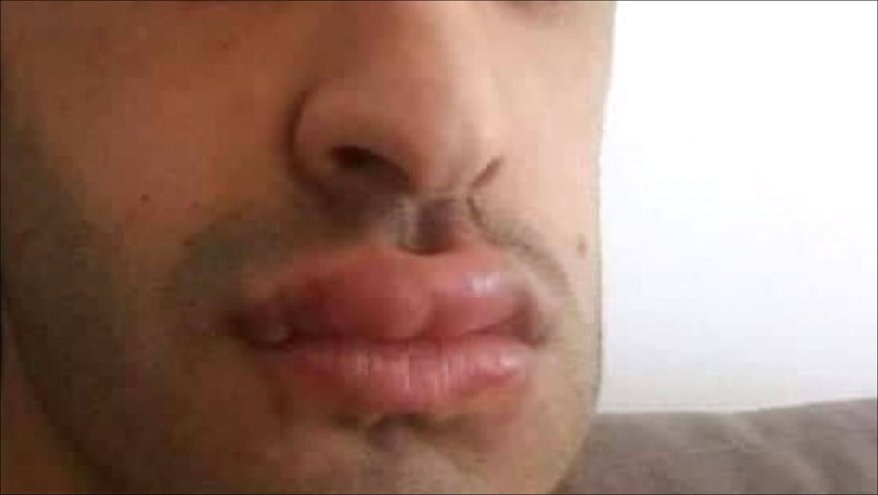 Photo showing patient presented several months later with upper and lower lip painless oedema.