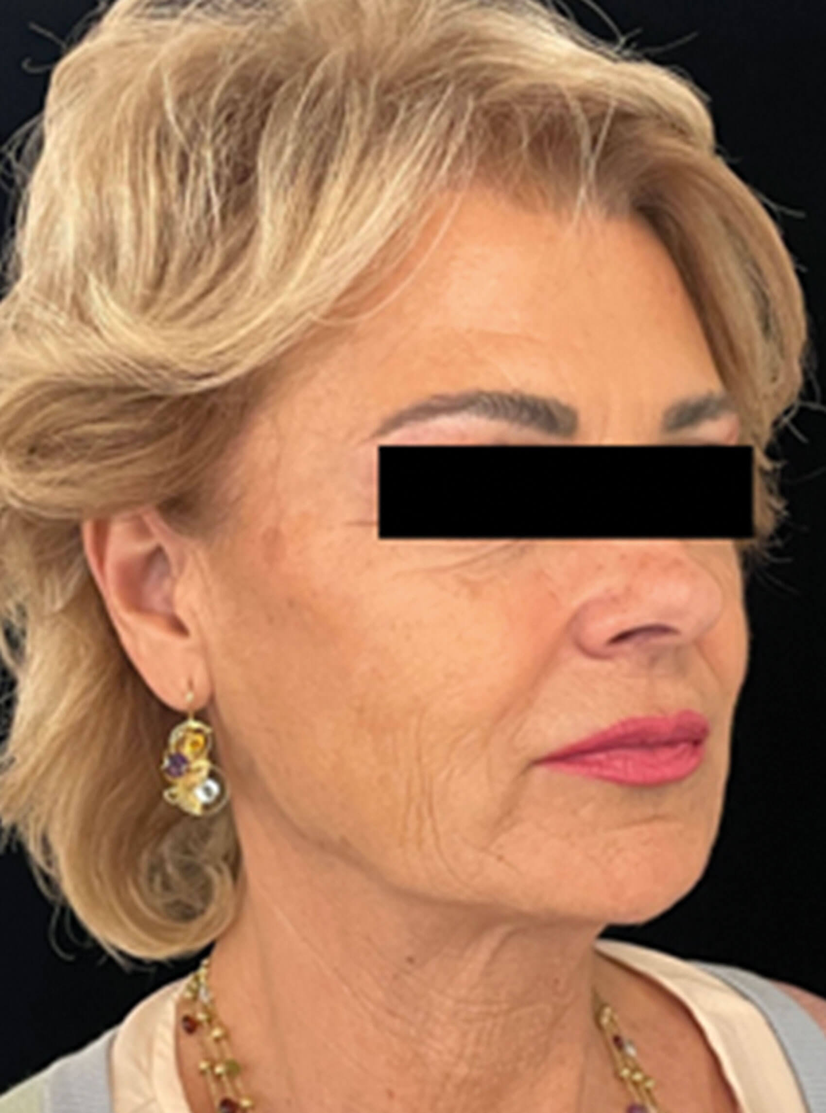 Photo showing patient three months after the second session of treatment. 