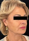 Photo showing patient three months after the second session of treatment.