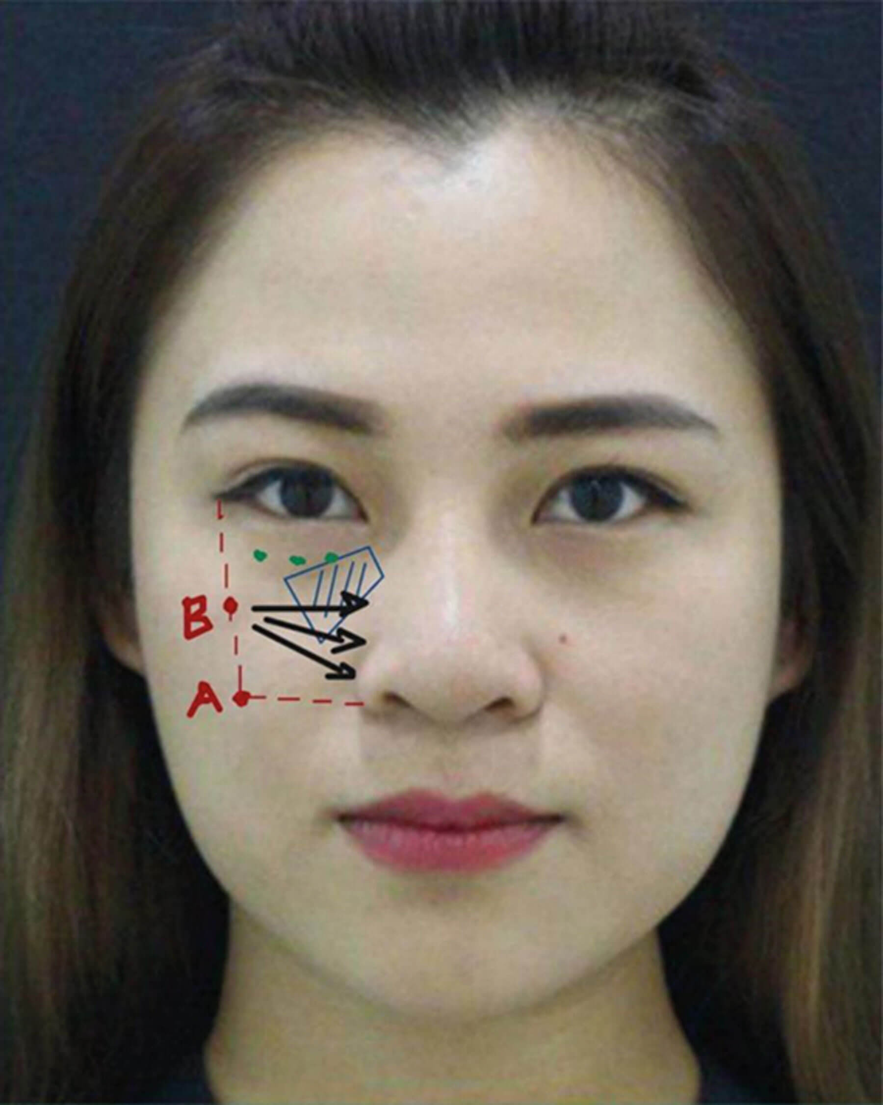 Demonstrating the technique image.