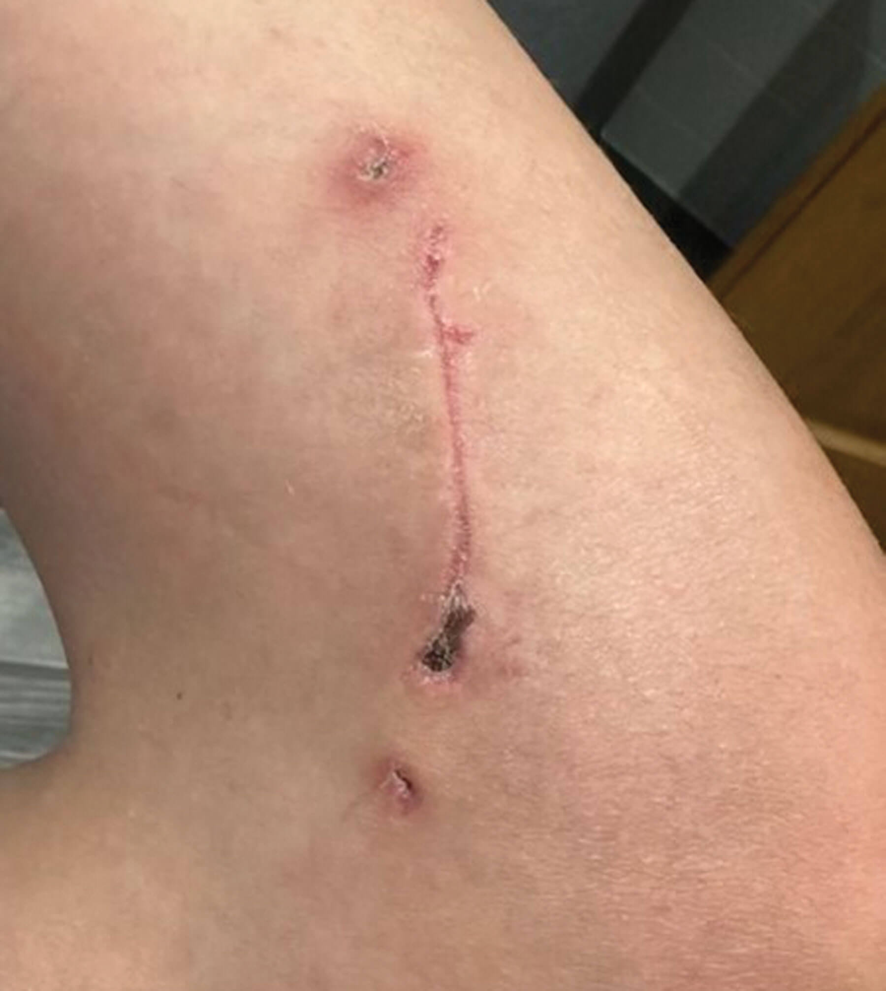 Photo showing closed surgical incision used for access to biopsy of femur. 