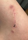 Photo showing closed surgical incision used for access to biopsy of femur.