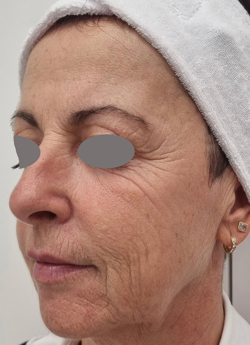 Photo of micro laser coring procedure.