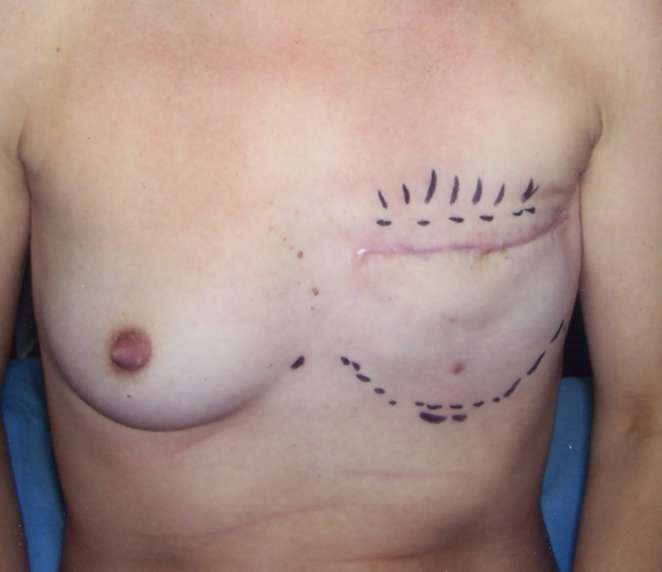 Photo showing nipple reconstruction procedure.
