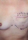 Photo showing nipple reconstruction procedure.