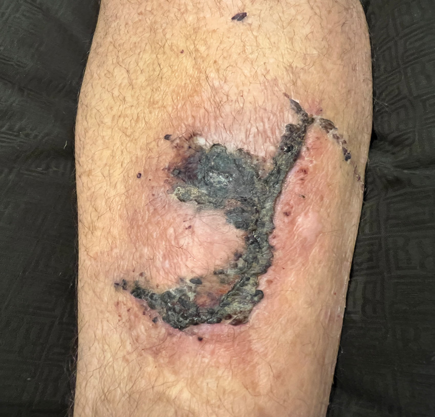 Photo showing wound after 22 days showing reduced inflammatory change and shrinkage of the crushed tissues.