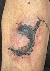 Photo showing wound after 22 days showing reduced inflammatory change and shrinkage of the crushed tissues.