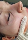 Nd:YAG Laser photo - before picture.