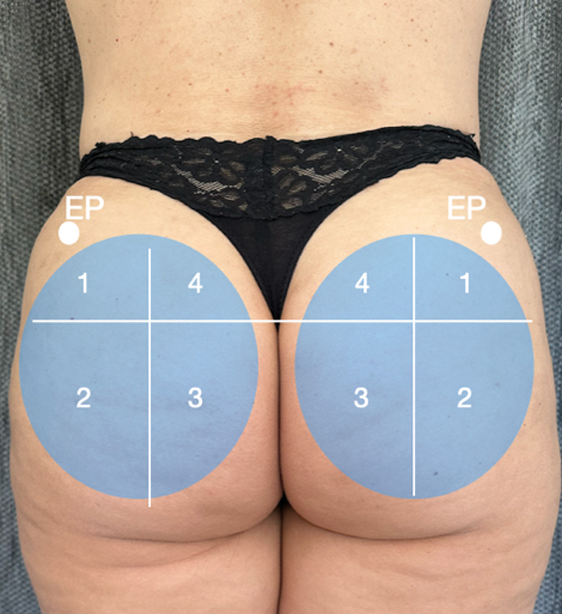 Photo showing pre-procedure marking of the buttocks showing the four gluteal quadrants.
