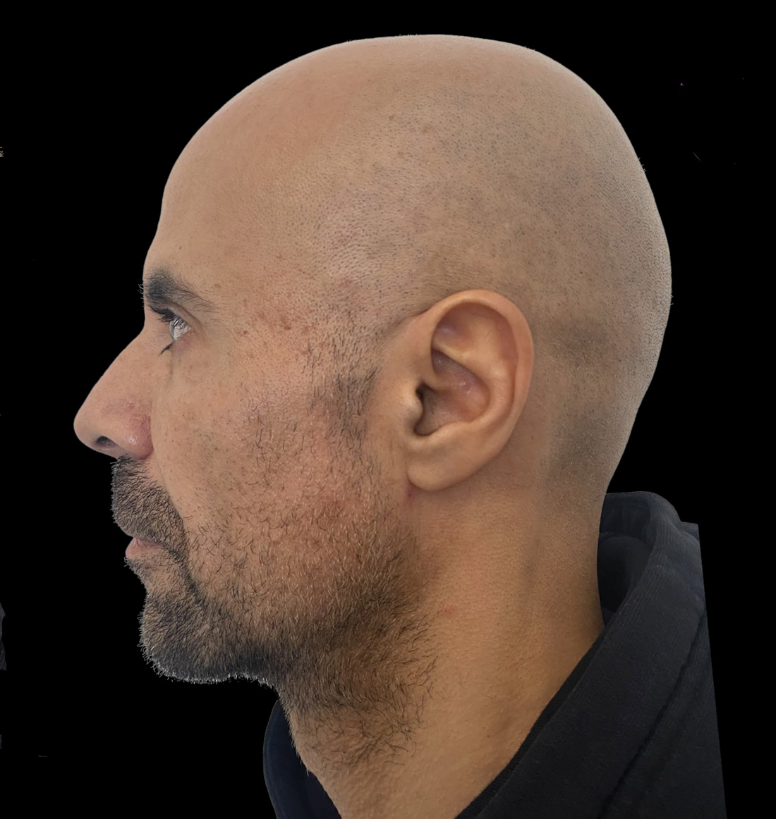 Aesthetic restoration photo.