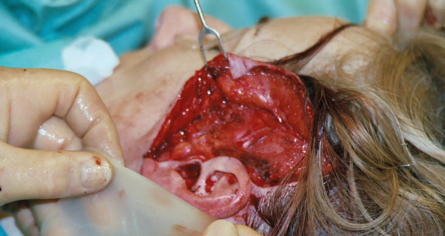 Photo showing IntegraTM about to be inserted over the plicated SMAS layer.
