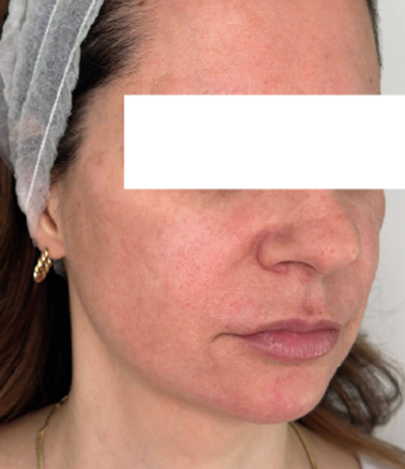 Photo showing patient after six weeks and one treatment.