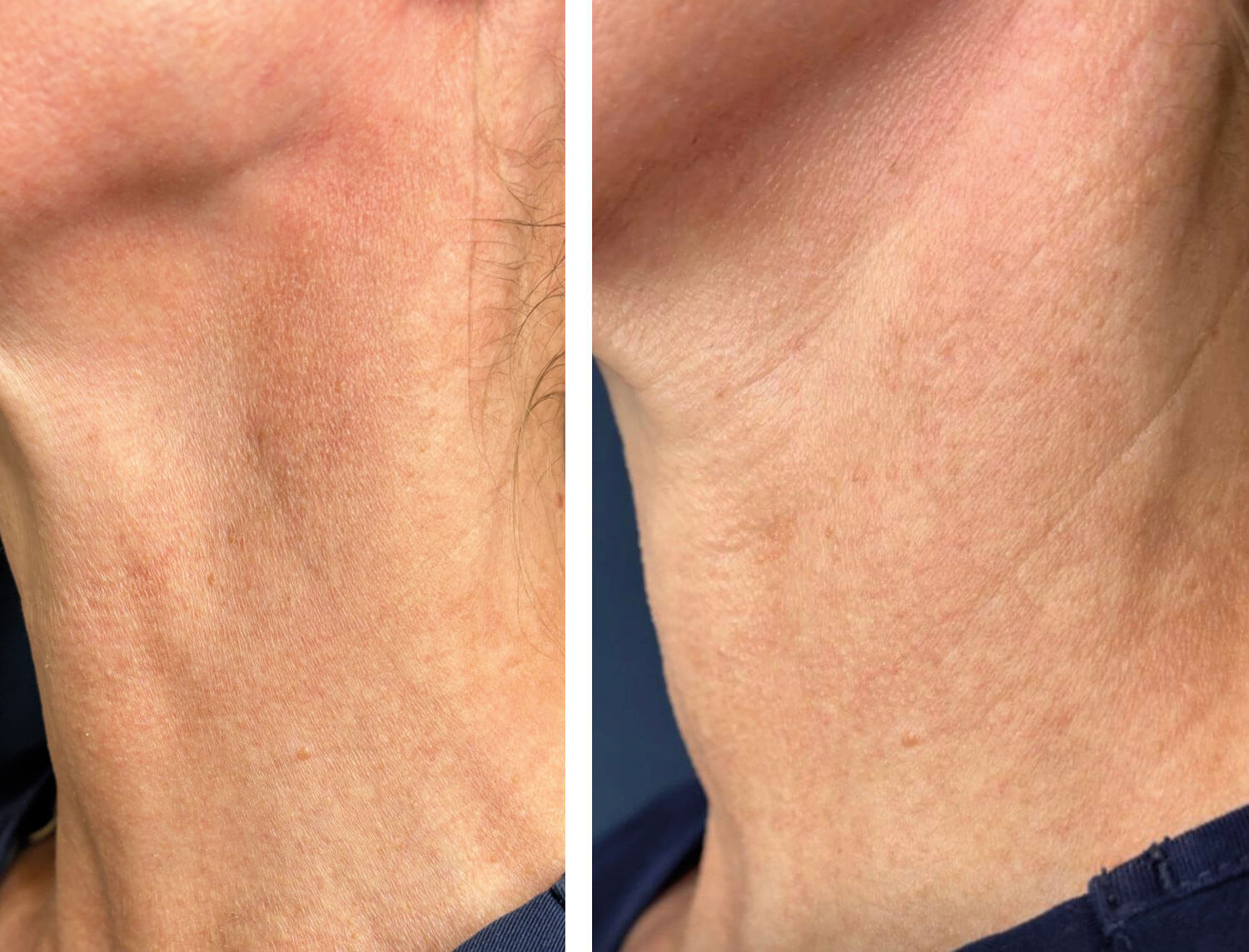 Photos showing neck rejuvenation.