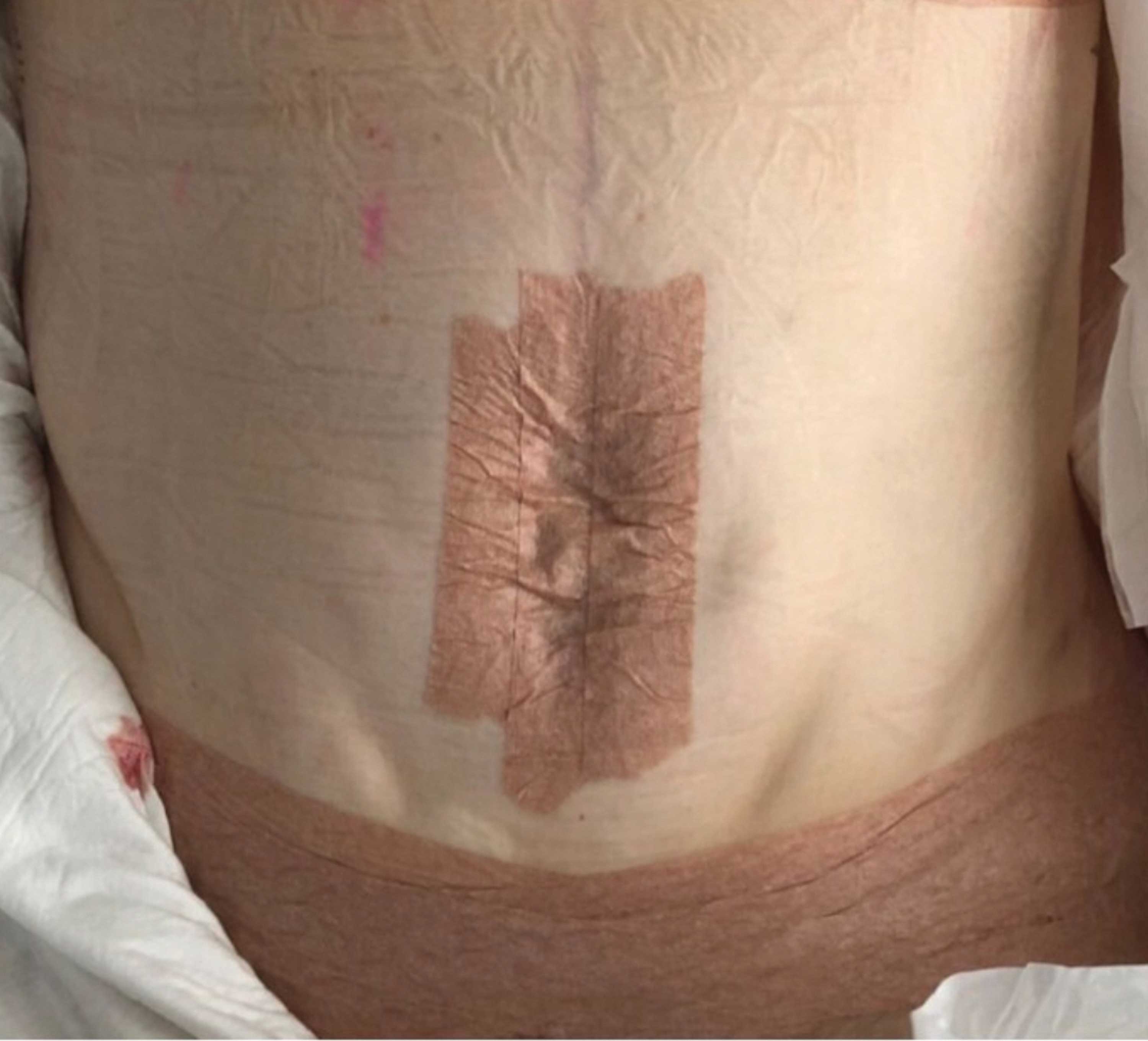 Image showing immediate post-abdominoplasty swelling with surgical dressings in place.