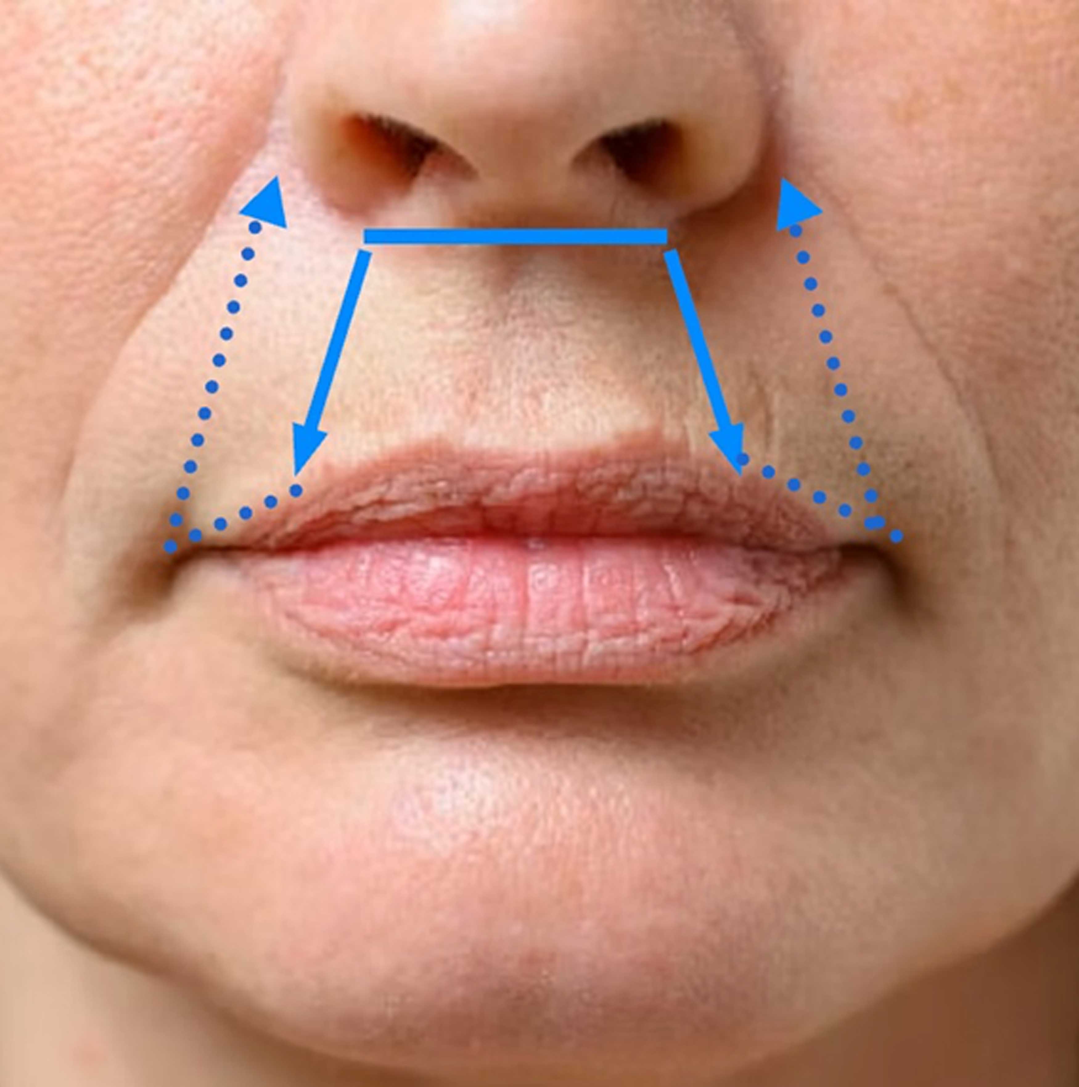Photo showing photo with schematic diagram of thread path and anchoring points.