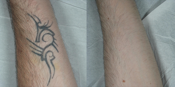 Laser tattoo removal: results and issues | The PMFA Journal