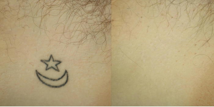laser tattoo removal results and issues the pmfa journal laser tattoo removal results and issues the pmfa journal
