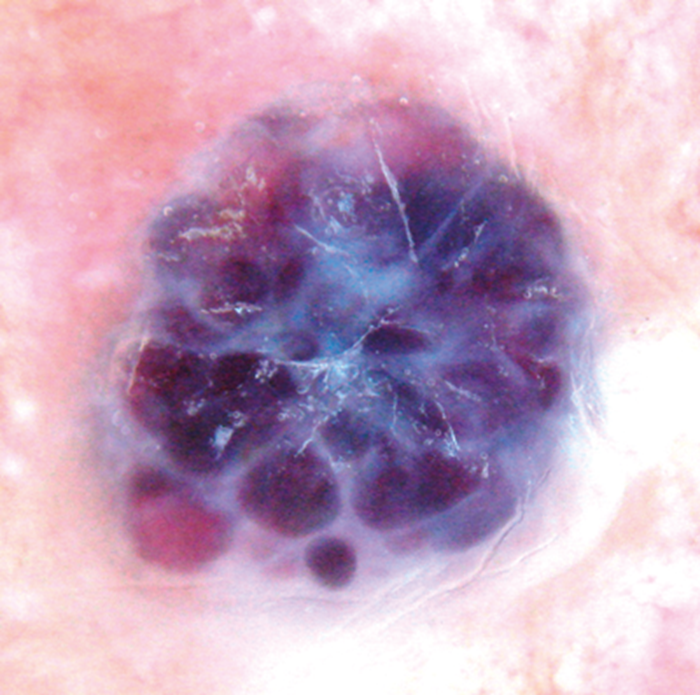 Dermoscopy an update and personal view The PMFA Journal