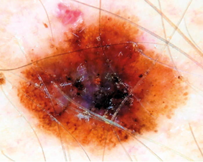 Dermoscopy an update and personal view The PMFA Journal