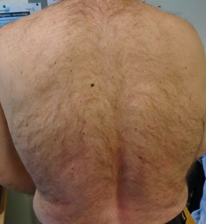Dermoscopy: an update and personal view | The PMFA Journal